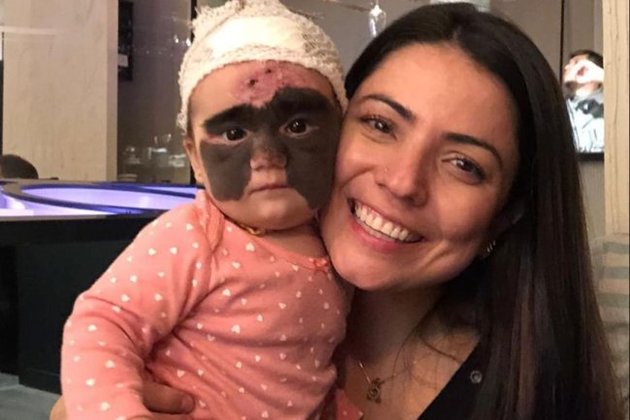 Girl with &#039;Batman mask&#039; birth mark gets anonymous donation from Russian to complete treatment